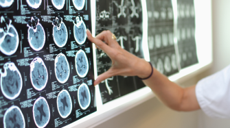 Scanner cérébral en train d'être interprété par l'un de nos neurologues de l'hôpital de Villefranche-sur-Saône